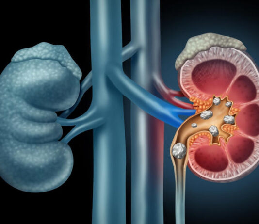 Makanan yang Bisa Merusak Ginjal, dari Soda hingga Garam